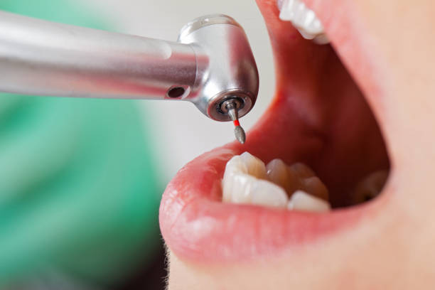 Best Emergency Root Canal Treatment in Jefferson City, TN